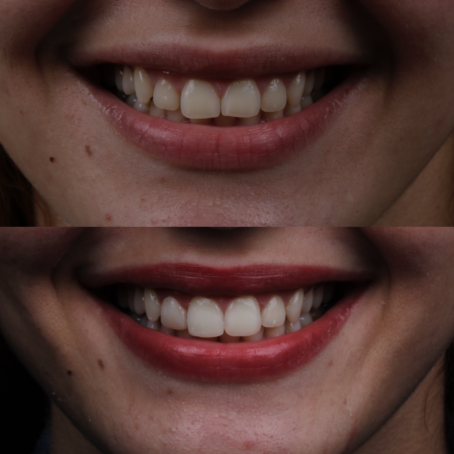 Antes e depois de lentes de contato dental, Dr. Pedro Campêlo — inclinic