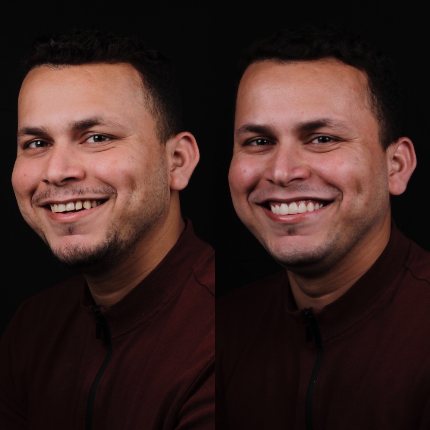 Antes e depois de reabilitação estética do sorriso na inclinic