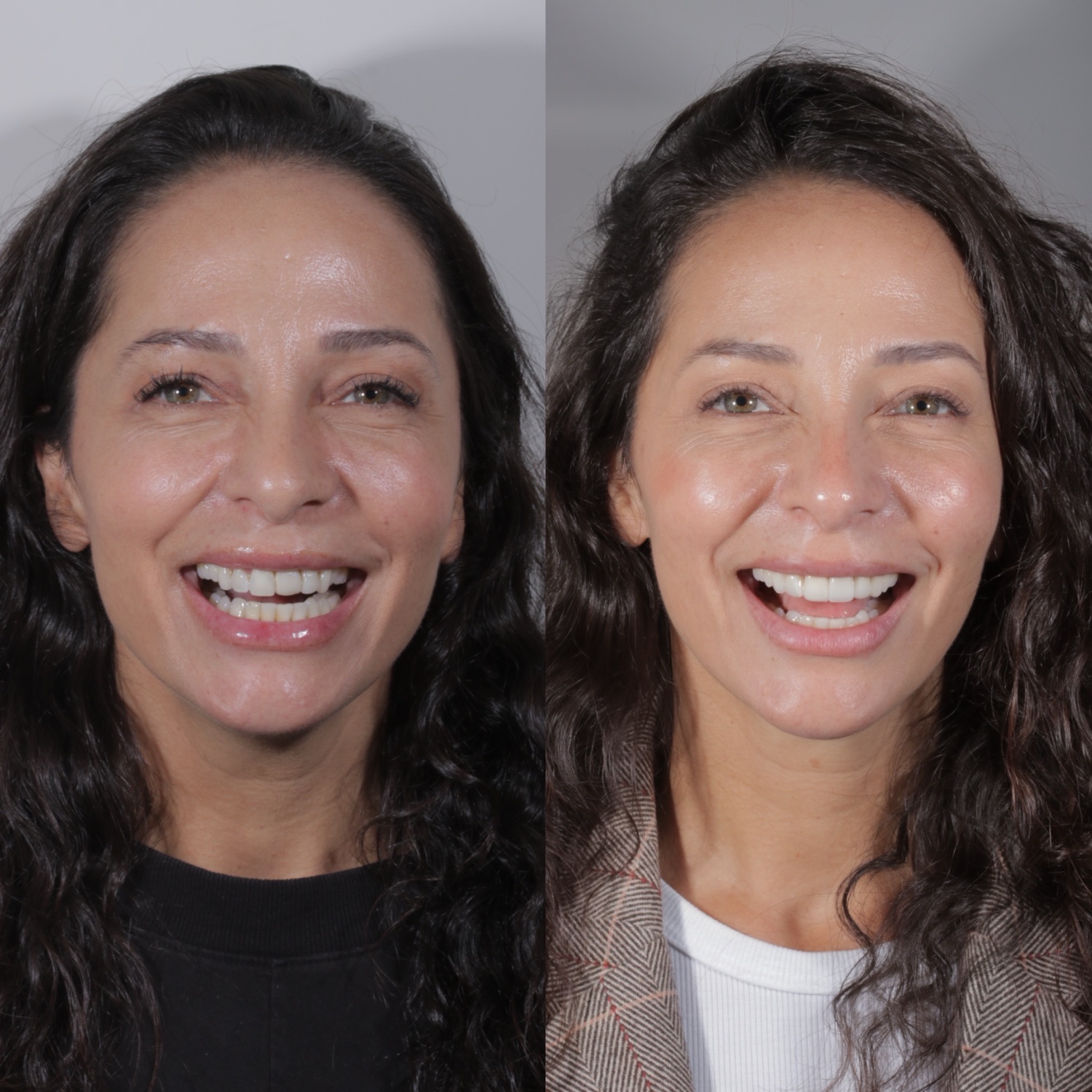 Antes e depois de lentes de contato dental na inclinic