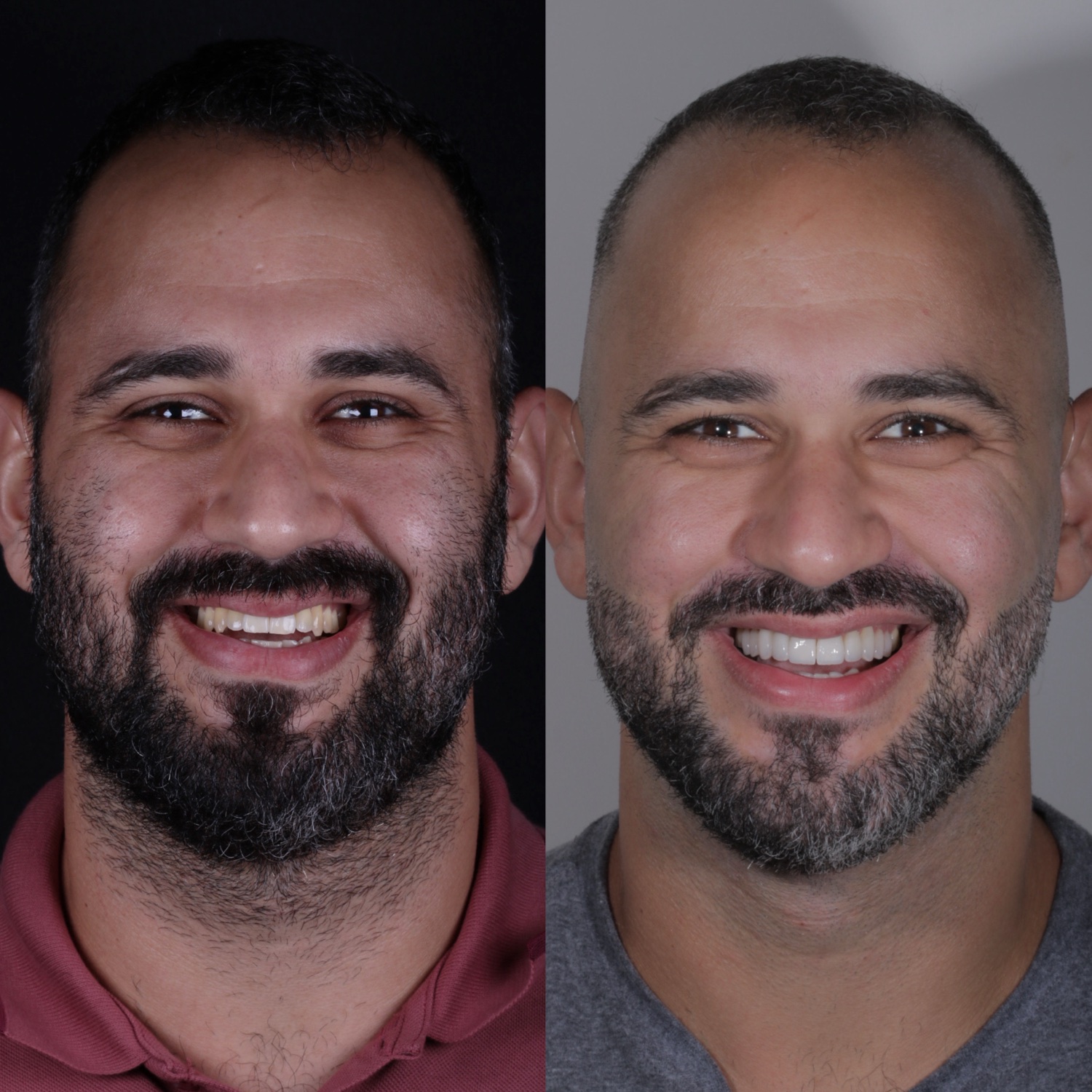 Antes e depois de lentes de porcelana, Dr. Pedro Campêlo — inclinic