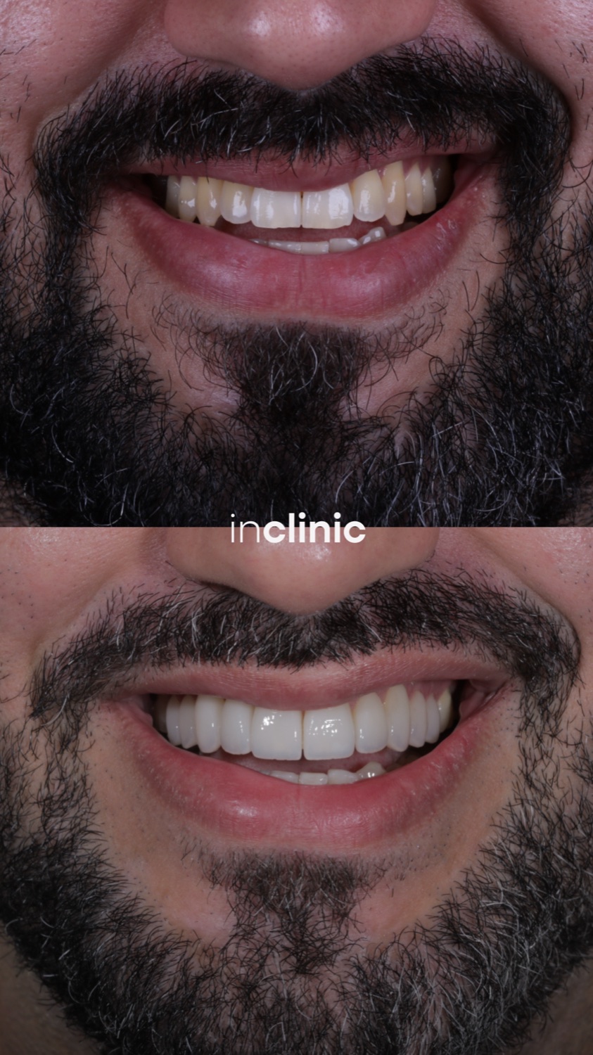 Antes e depois de design digital do sorriso, Dr. Pedro Campêlo — inclinic