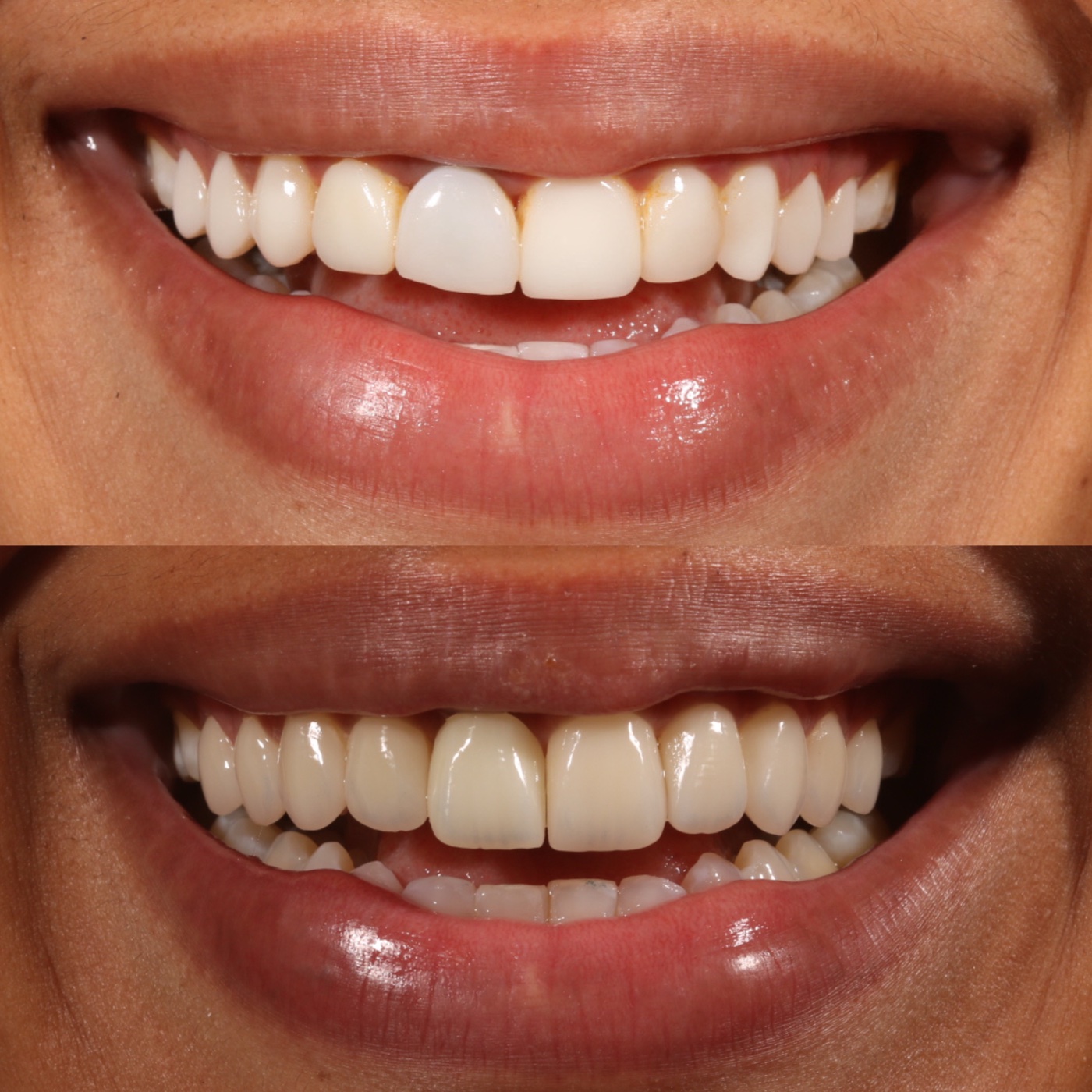 Antes e depois de clareamento e alinhamento do sorriso na inclinic